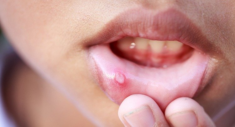 口腔潰瘍是火氣大還是癌變？醫師教從時間和形狀分辨