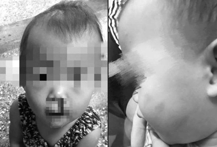 1歲半女童疑遭爆打巴掌「流鼻血」！母怒控公托虐童　台東縣府出手了