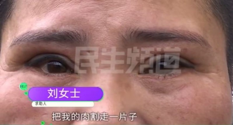 萬人迷熟女做醫美「肉被割走」　勾人眼消失爆哭：我現在像妖怪！