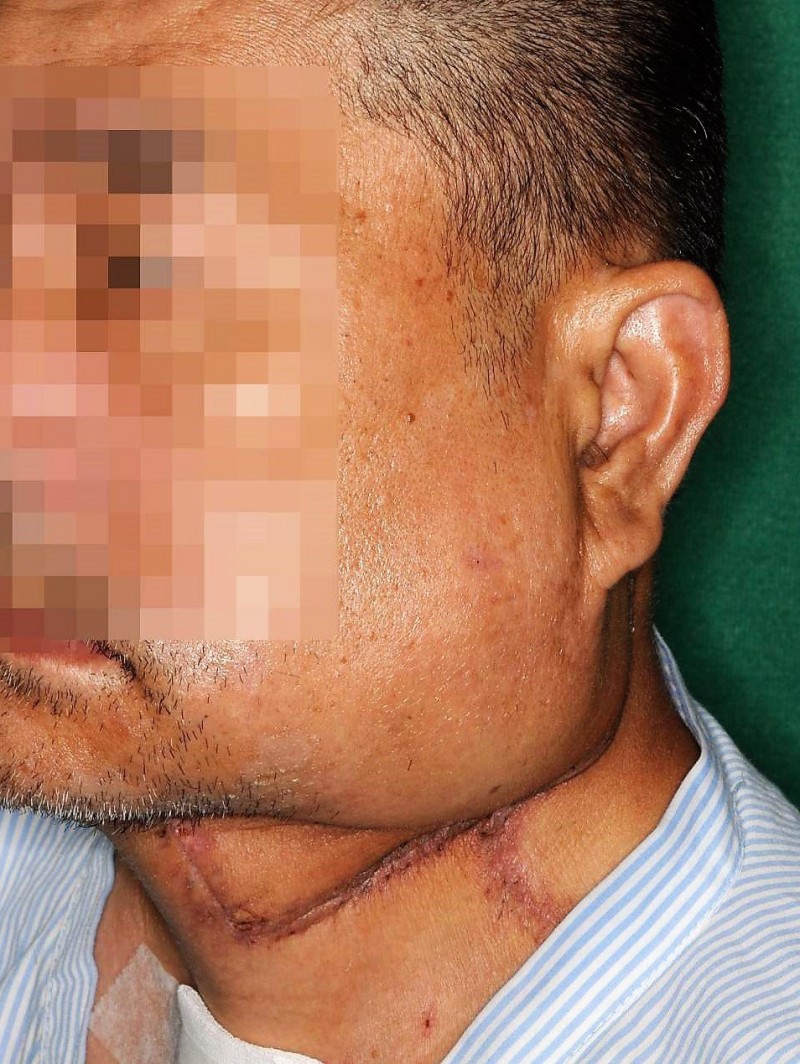 40歲壯男吸菸嚼檳榔得口腔癌 手術取小腿骨與皮膚重建