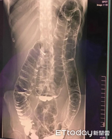 「大腸長到心臟」X光片看傻　17天沒嗯嗯！23歲妹哭：只能切掉嗎