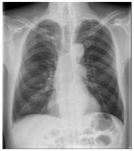 連4年健檢正常竟罹肺癌？ 醫師曝原因：X光不一定看得到